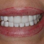 Turkey Teeth Regret: What to Know Before Booking Veneers Abroad