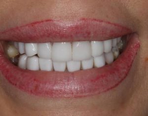 Turkey Teeth Regret: What to Know Before Booking Veneers Abroad