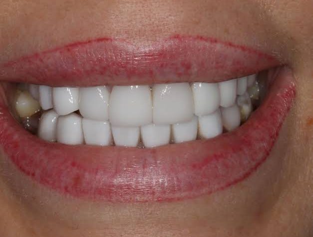 Turkey Teeth Regret: What to Know Before Booking Veneers Abroad