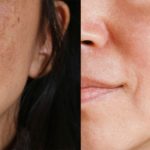 The Real Reasons Behind Rough Uneven Skin