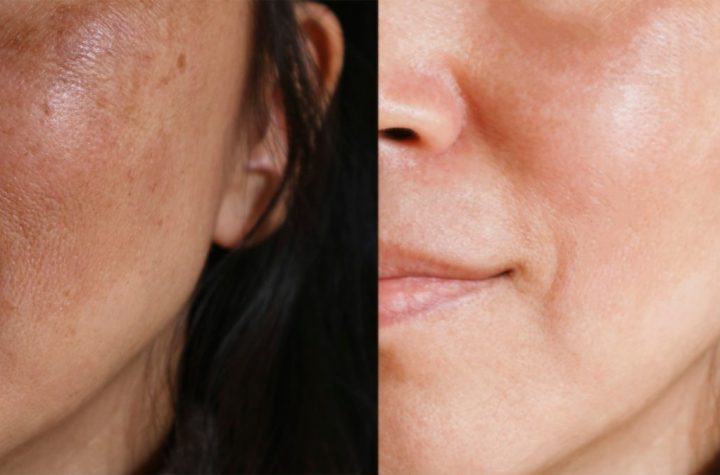 The Real Reasons Behind Rough Uneven Skin