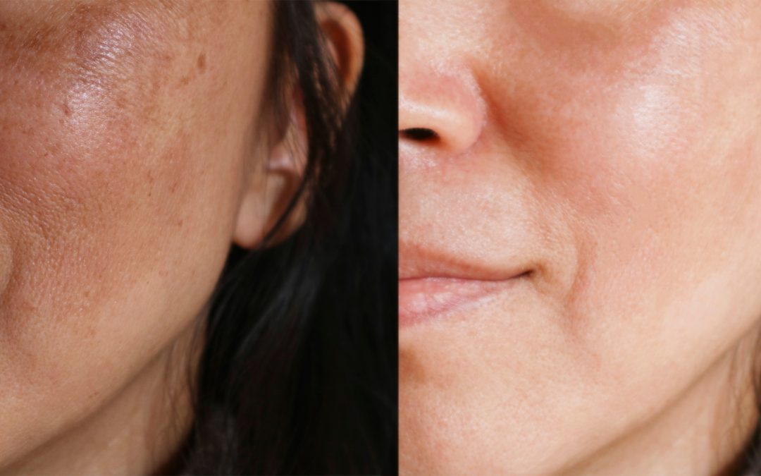 The Real Reasons Behind Rough Uneven Skin